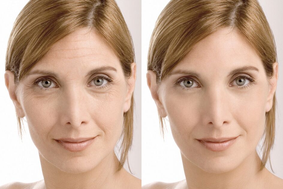 Experience using before and after using intenskin cream from Milana